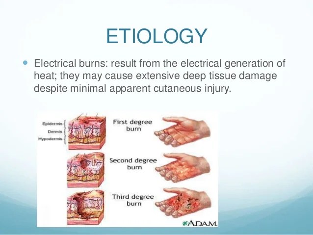 burns ppt.