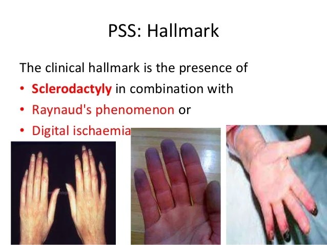 Progresive systemic sclerosis