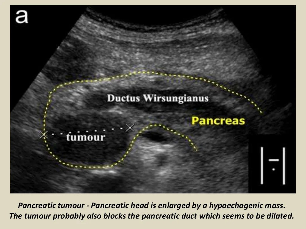 Ultrasound of pancrease in Radiology