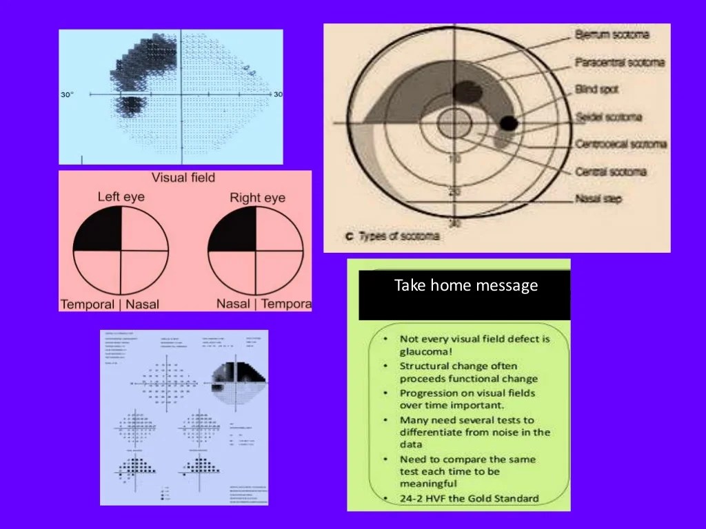 Visual field analysisinterpretation