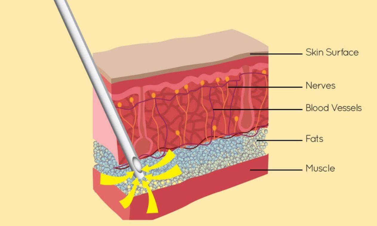 Liposuction (Remove Fat from Specific Areas of the Body) Trambellir