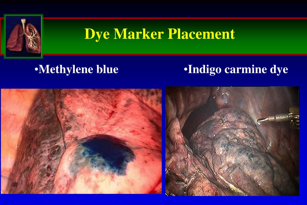 PPT Navigational Bronchoscopy versus CTguided biopsy