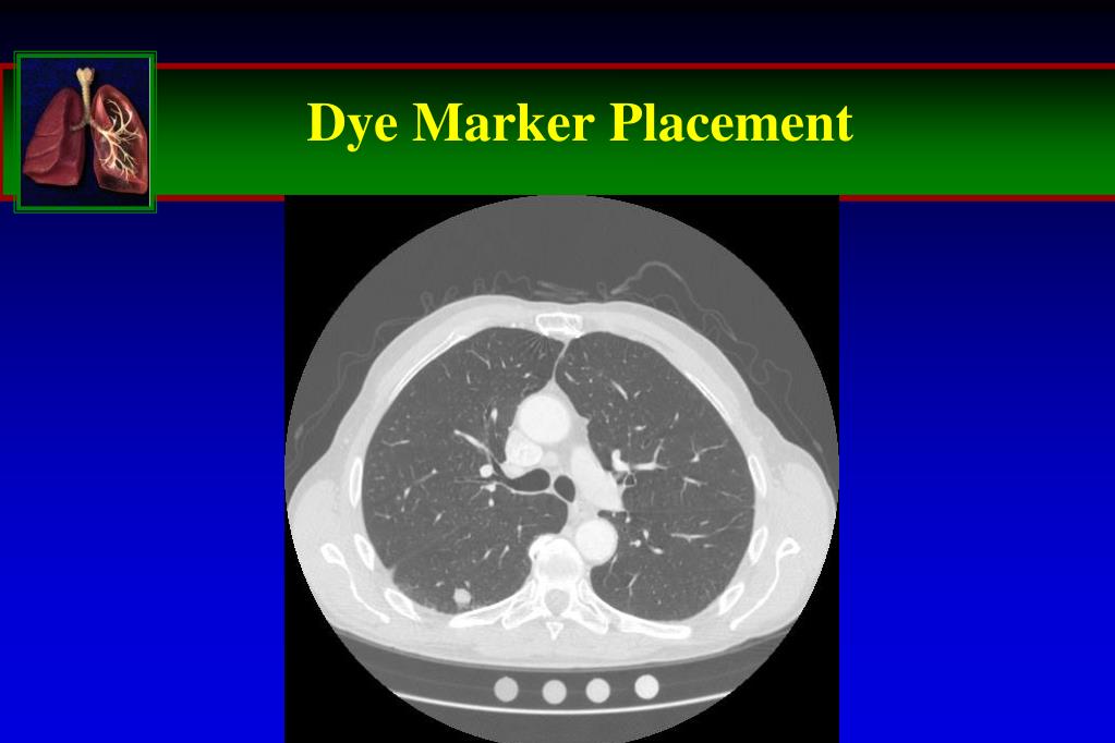 PPT Navigational Bronchoscopy versus CTguided biopsy