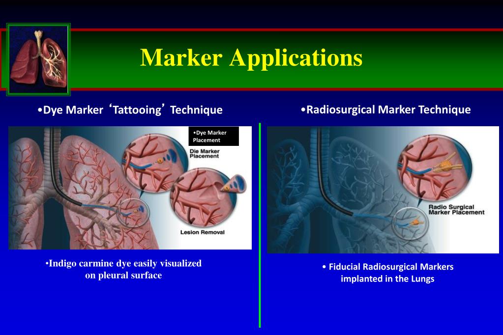 PPT Navigational Bronchoscopy versus CTguided biopsy