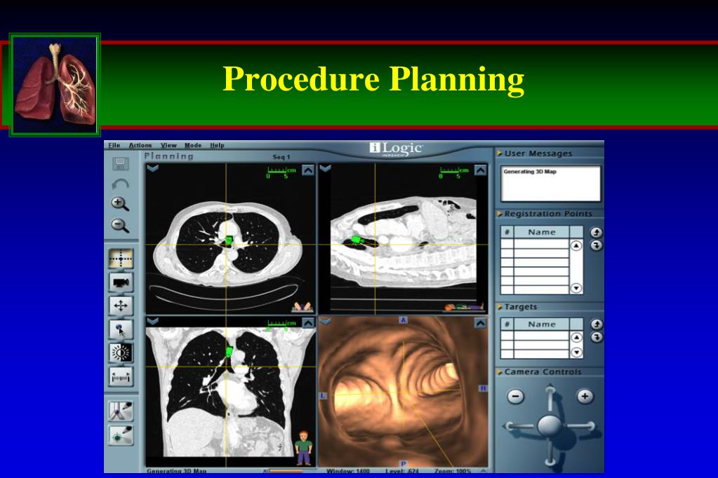PPT Navigational Bronchoscopy versus CTguided biopsy