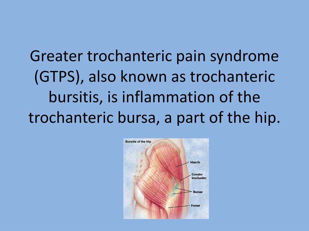 Hip Pain Trochanteric Bursitis Treatment