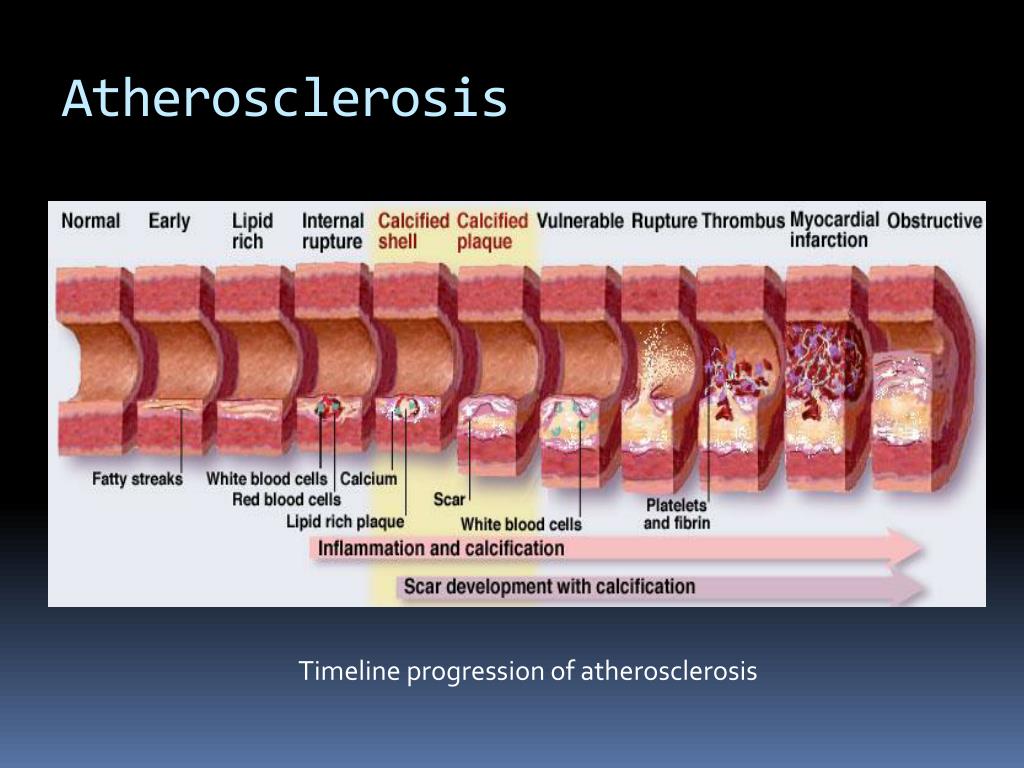 PPT Targeted Drug Delivery to Atherosclerotic Plaques PowerPoint Presentation ID1698199