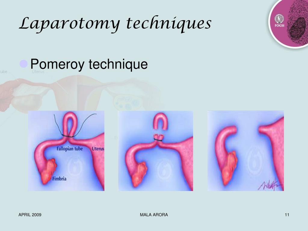 PPT FEMALE STERILIZATION PowerPoint Presentation, free download ID1711364