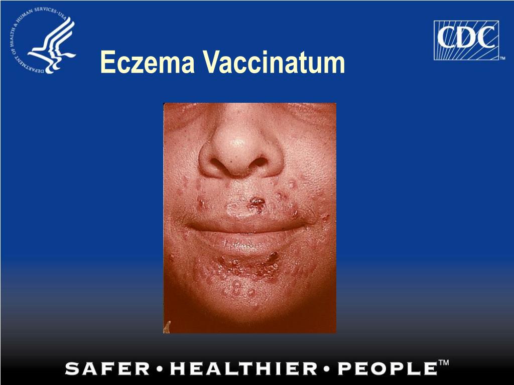PPT Eczema Vaccinatum PowerPoint Presentation, free download ID1716361