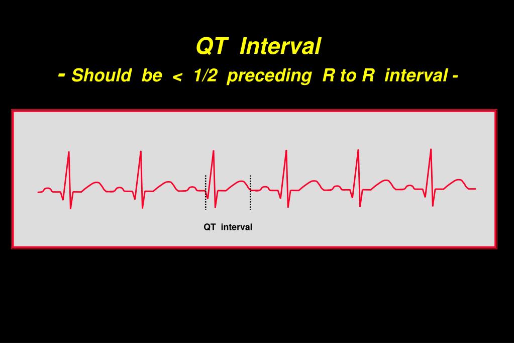 PPT EKG Dysrhythmia PowerPoint Presentation, free download