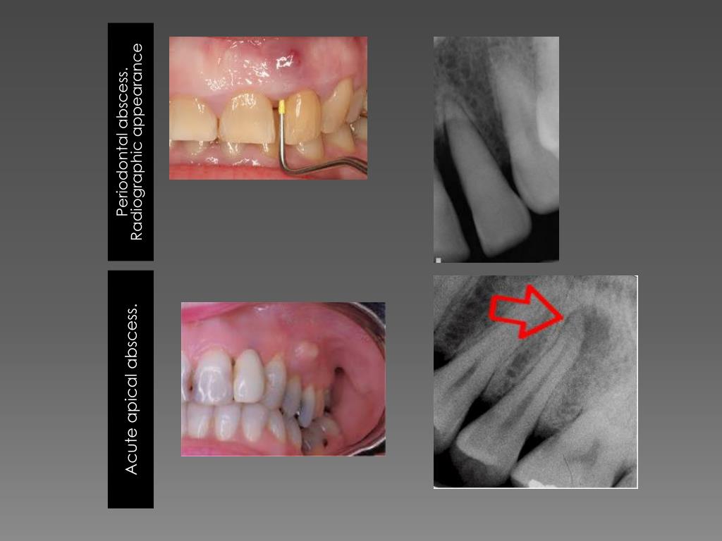 PPT Endodontic Emergencies PowerPoint Presentation, free download ID1781862