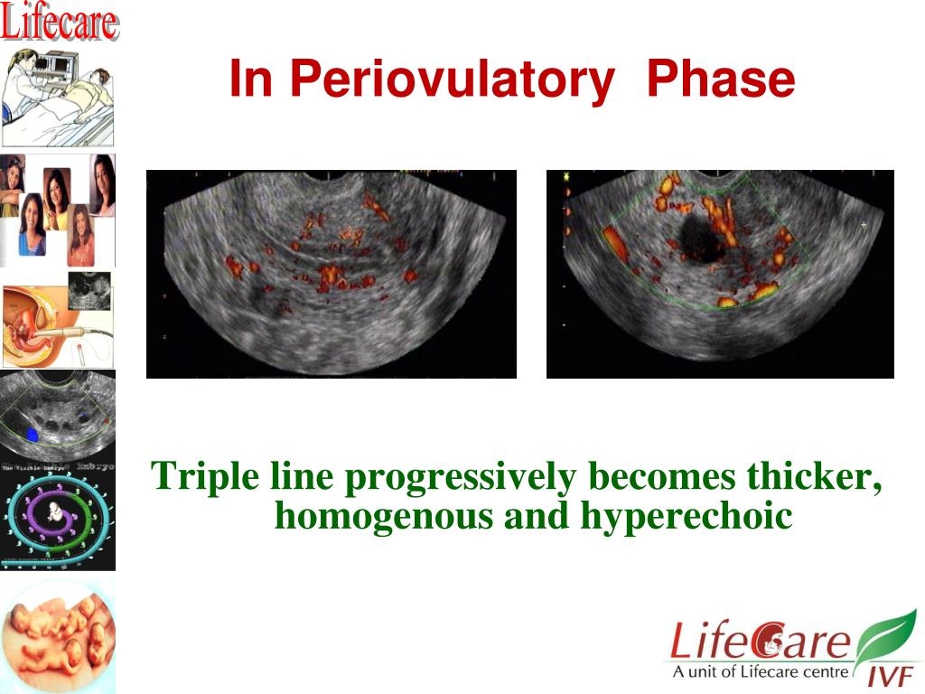 PPT Practical tips for monitoring of an IUI cycle PowerPoint