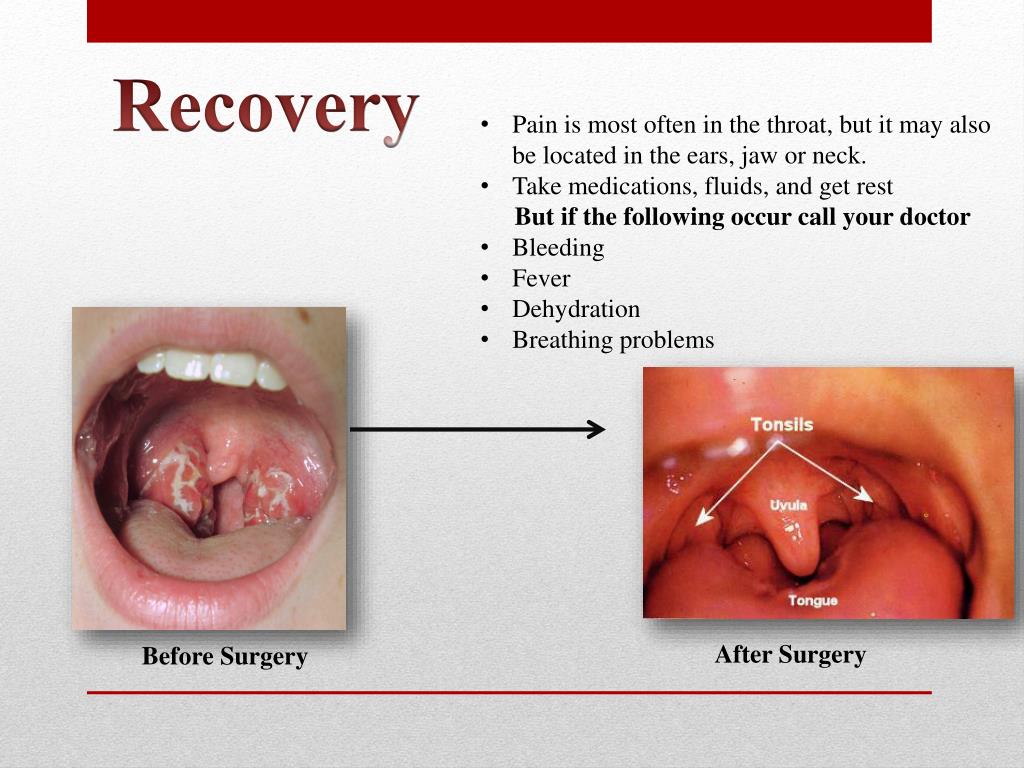 PPT Tonsillitis PowerPoint Presentation, free download ID1857321