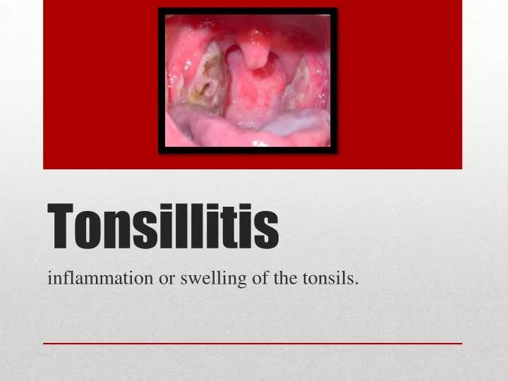PPT Tonsillitis PowerPoint Presentation, free download ID1857321