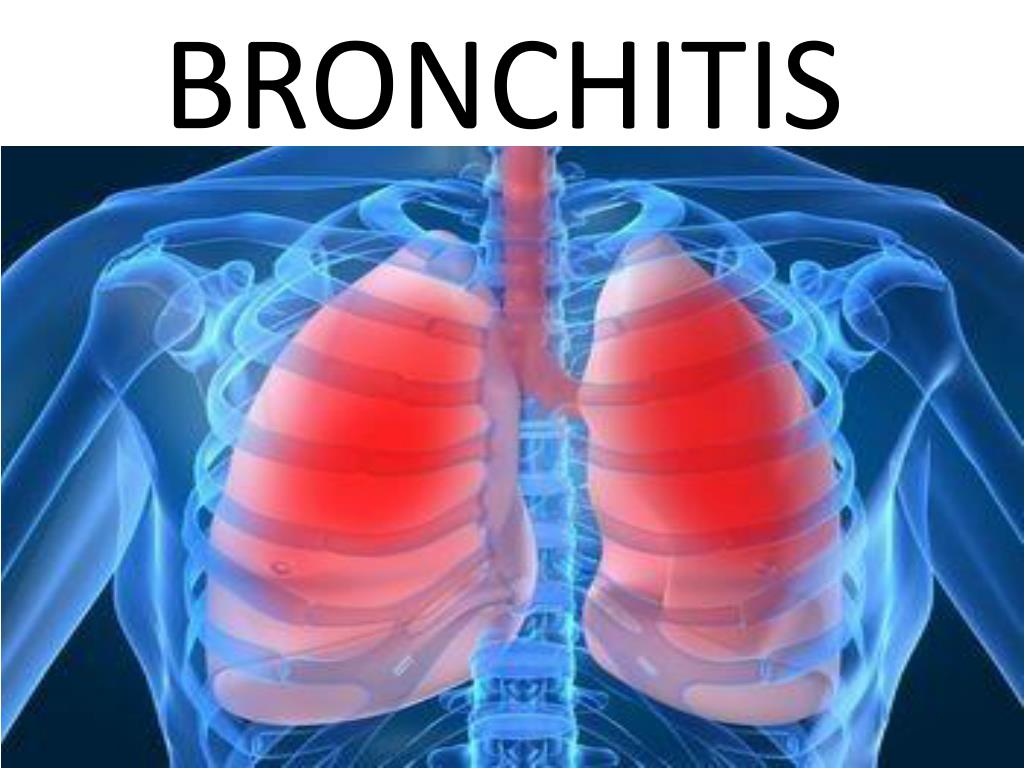 PPT BRONCHITIS PowerPoint Presentation, free download ID1857430