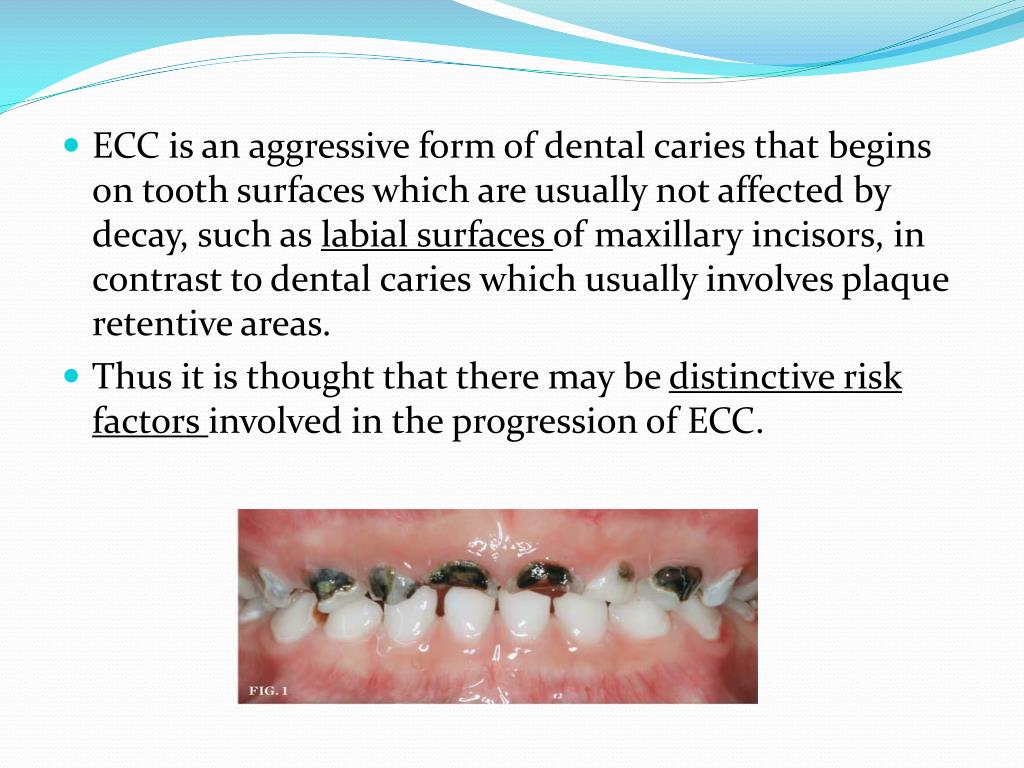 PPT Early Childhood Caries (ECC) PowerPoint Presentation, free