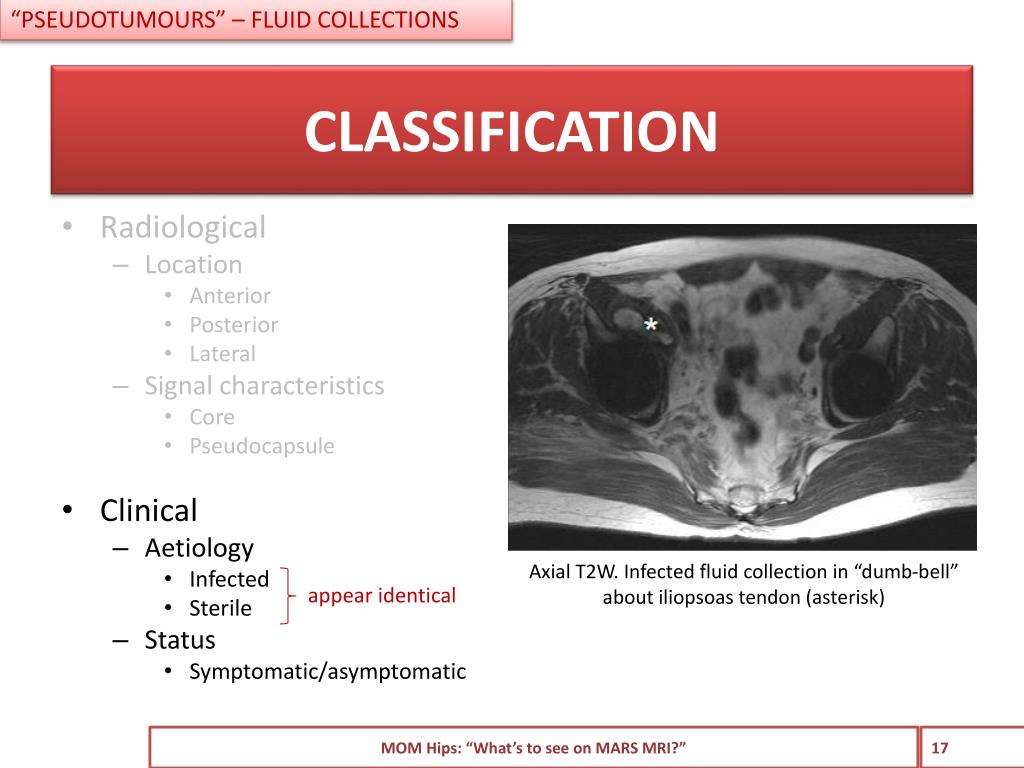PPT Metalonmetal hips. “What’s to see on MRI?” PowerPoint