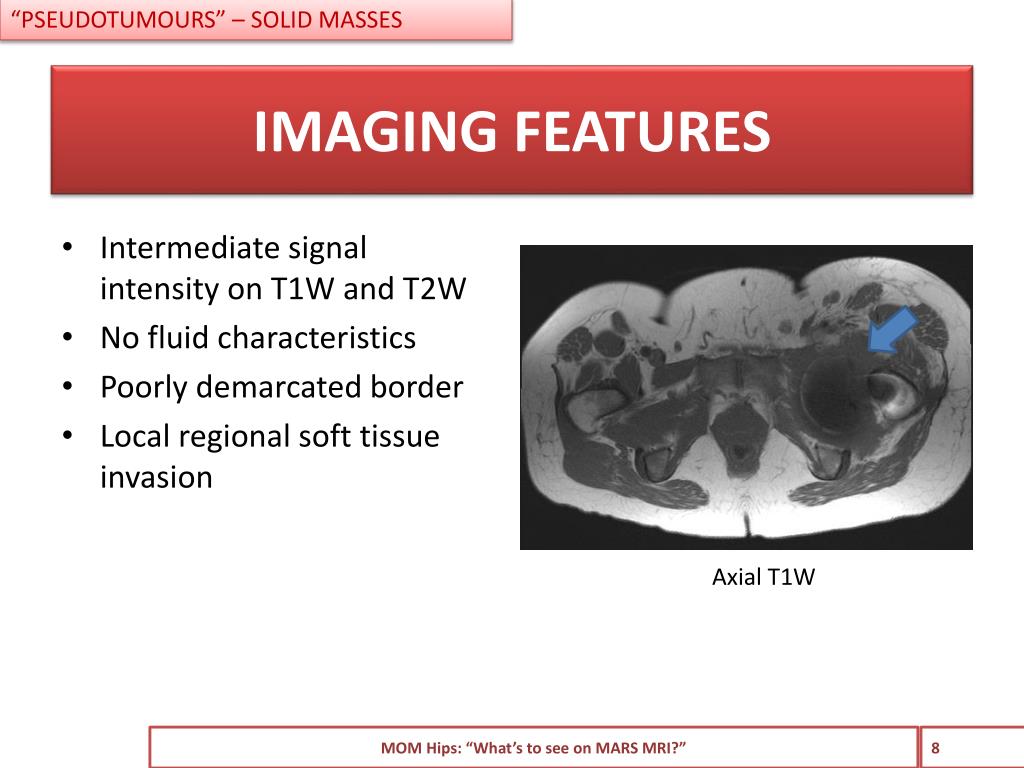 PPT Metalonmetal hips. “What’s to see on MRI?” PowerPoint