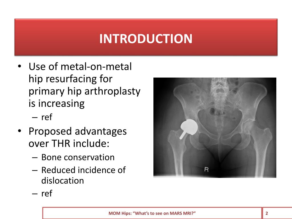 PPT Metalonmetal hips. “What’s to see on MRI?” PowerPoint