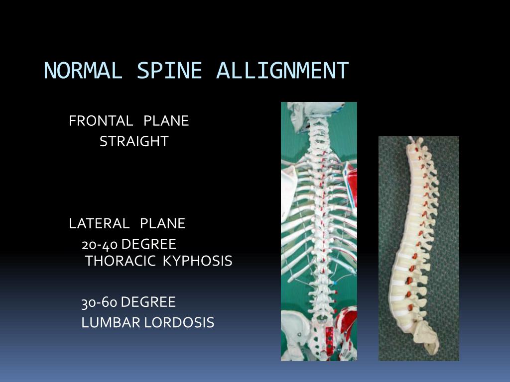 PPT SPINAL DEFORMITIES PowerPoint Presentation, free download ID1867421