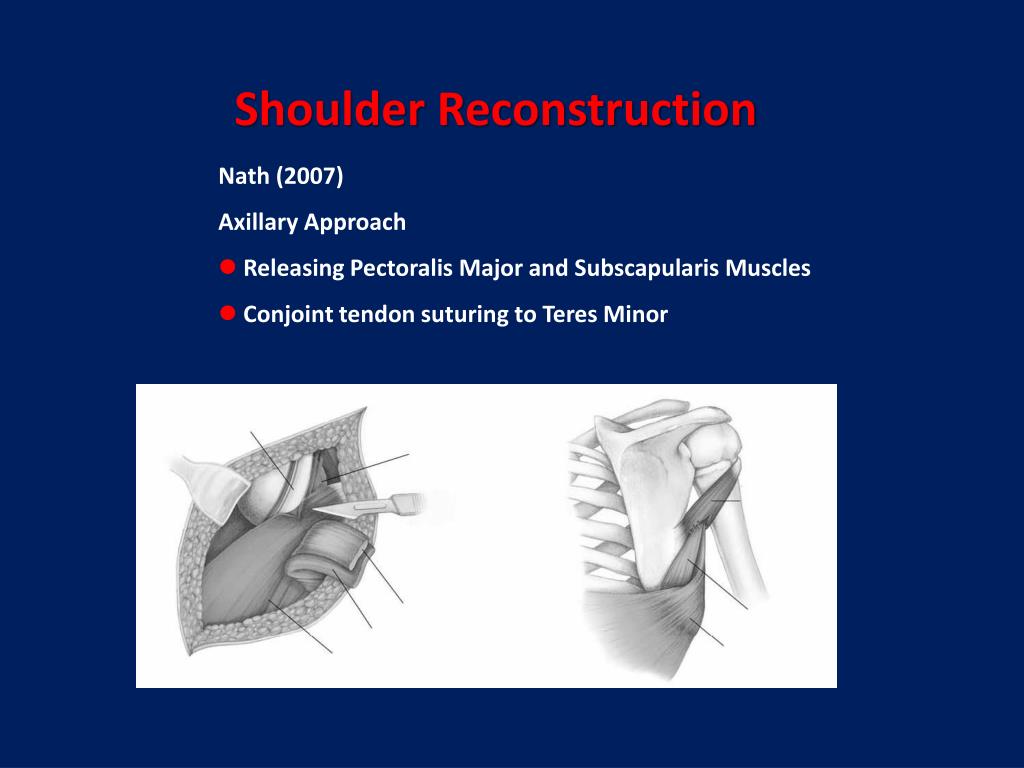 PPT Gong Xu , Lu Lai Jin, Cui Jian Li, Sun Ru Tao Department of Hand Surgery PowerPoint