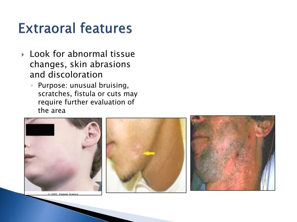 PPT EXTRA AND INTRA ORAL EXAMINATION PowerPoint Presentation, free