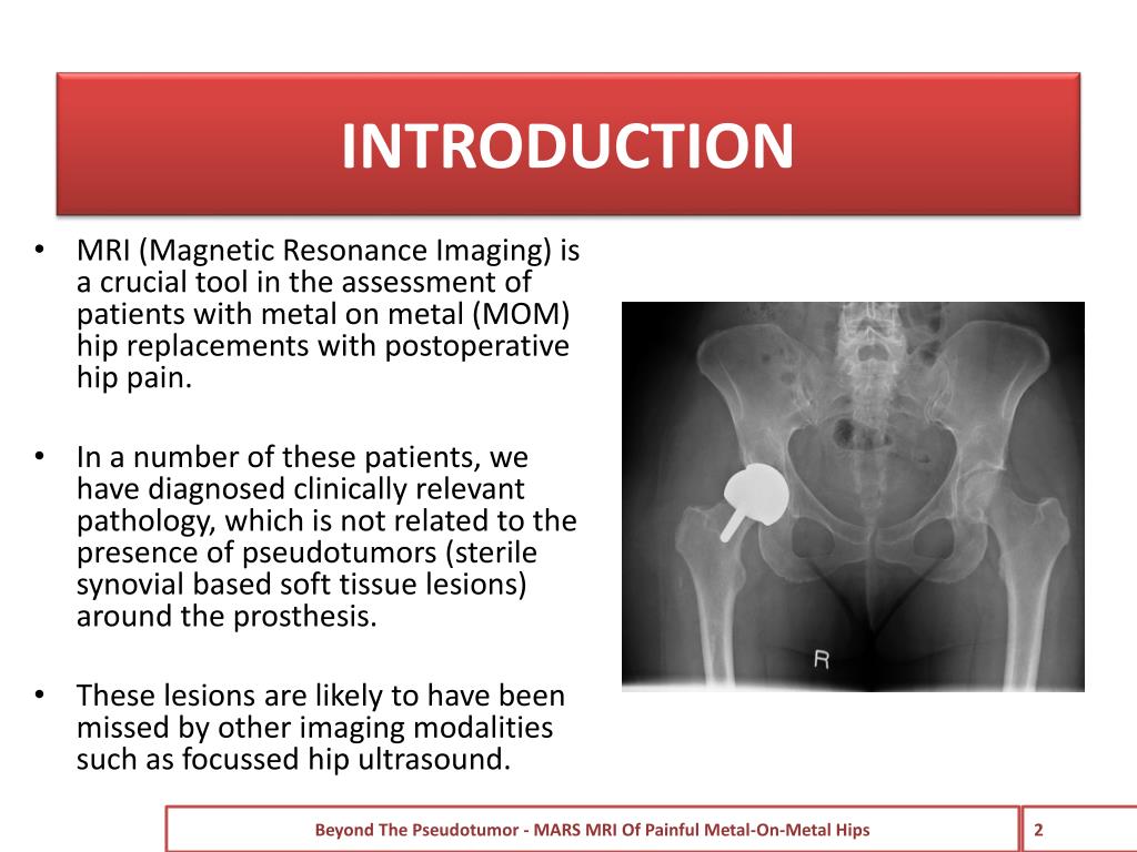 PPT Beyond the Pseudotumor mars mri of painful metalonmetal hips
