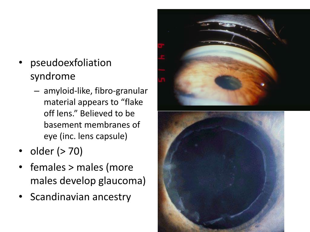 PPT “Bull’s Eye” Maculopathy PowerPoint Presentation, free download