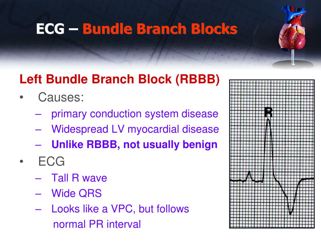 There is no evidence to suggest established rbbb carries other than a normal. Right bundle branch block patterns with a normal duration of qrs complex are quite common in healthy people. PPT Electrocardiogram PowerPoint Presentation, free download ID1910947