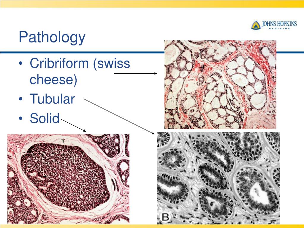 PPT Adenoid Cystic Carcinoma A clinical and molecular review