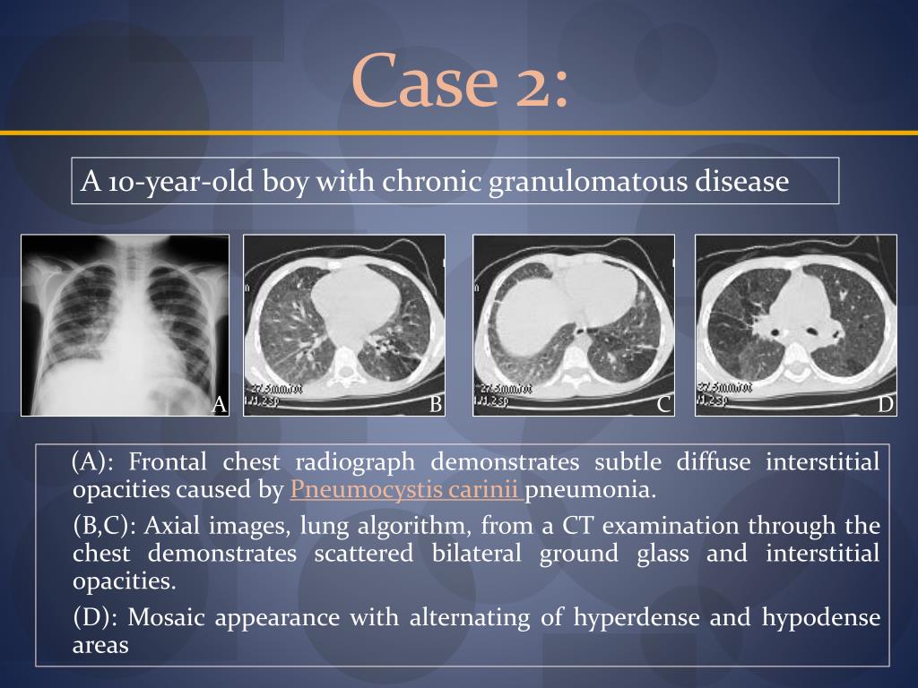 PPT IMAGING OF CHEST INFECTIONS IN CHILD PowerPoint
