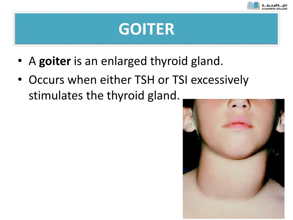 PPT ABNORMALITIES OF THYROID FUNCTION PowerPoint Presentation, free