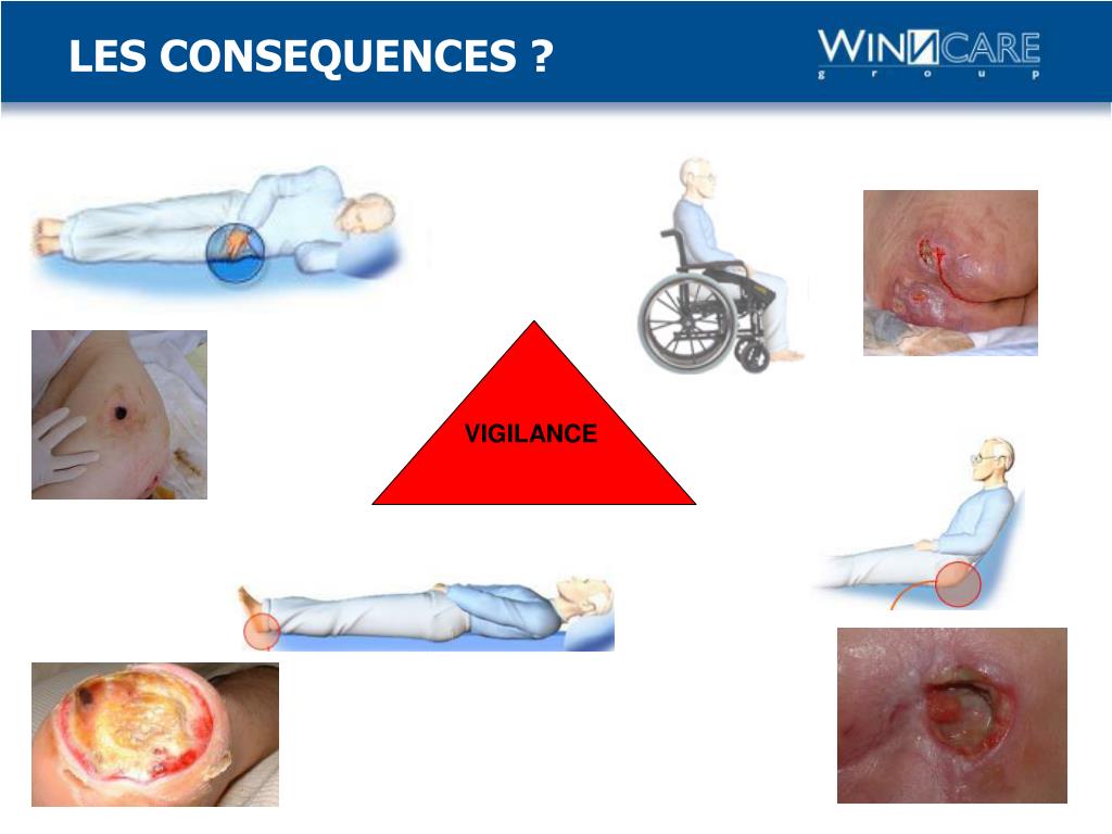 PPT La physiopathologie des Escarres PowerPoint Presentation, free