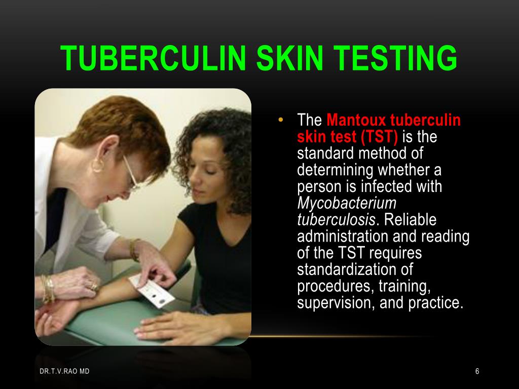 PPT Tuberculin skin Testing Mantoux tuberculin skin test PowerPoint Presentation ID2024960