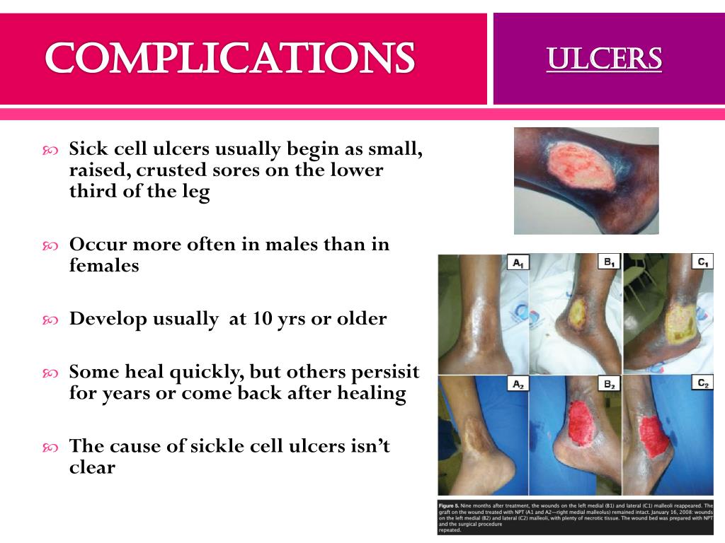 Sickle Cell In Black Males