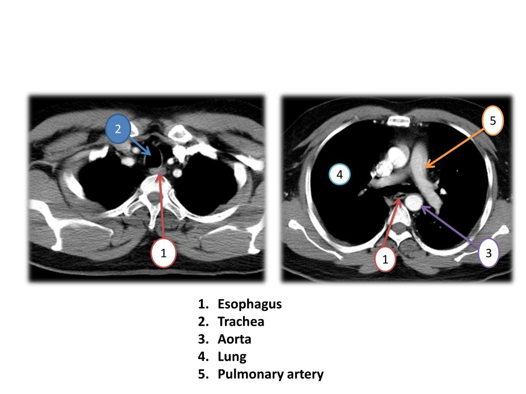 PPT RADIOLOGY OF ESOPHAGUS AND STOMACH PowerPoint Presentation, free