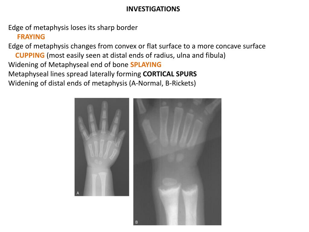 PPT RICKETS PowerPoint Presentation, free download ID2040591