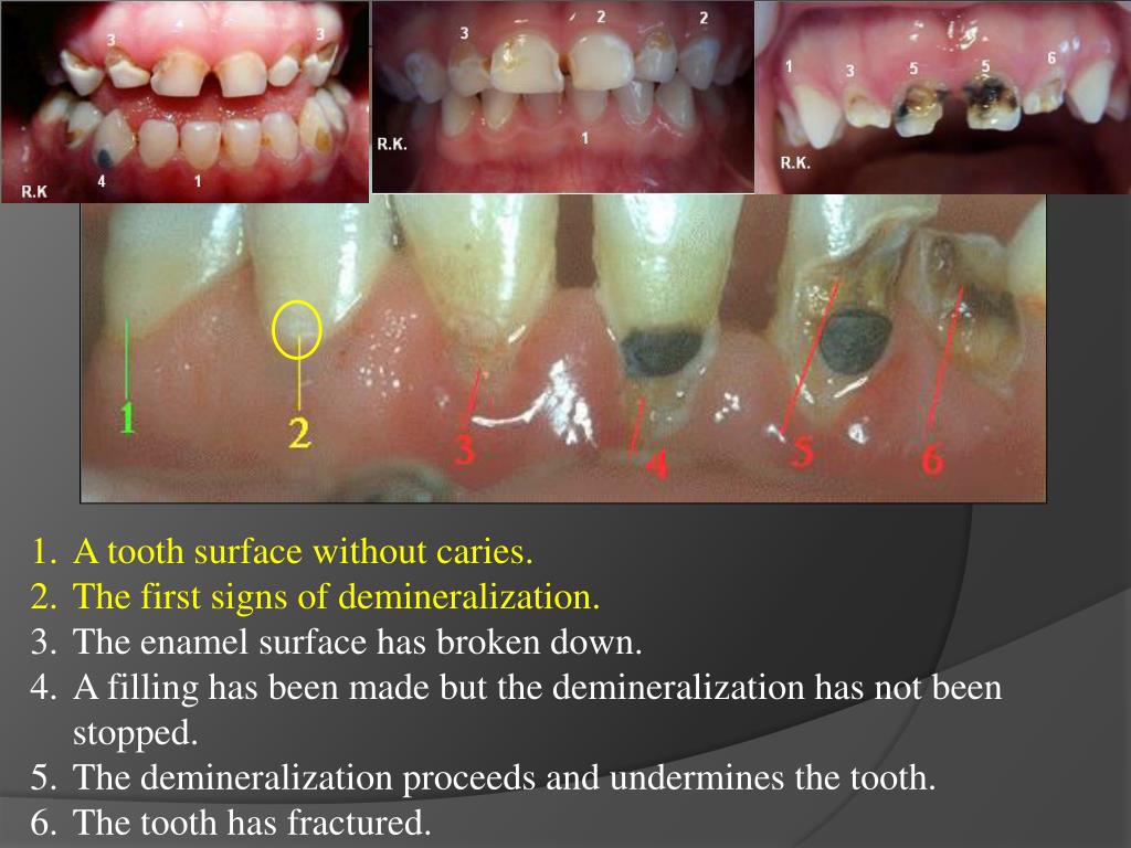 PPT Histopathology of Dental Caries PowerPoint Presentation, free