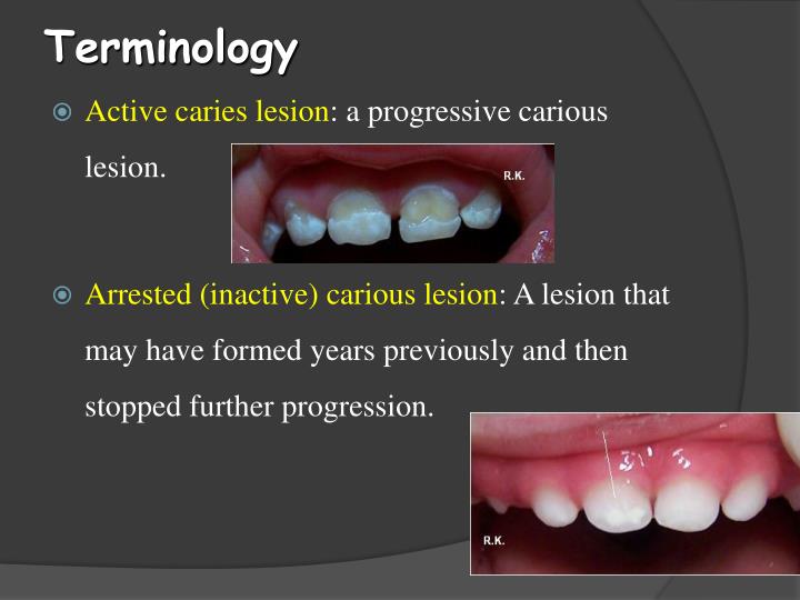 PPT Histopathology of Dental Caries PowerPoint Presentation ID2053621