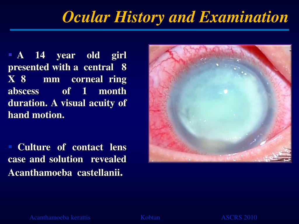 PPT Management of a Case of Advanced Acanthamoeba keratitis in a