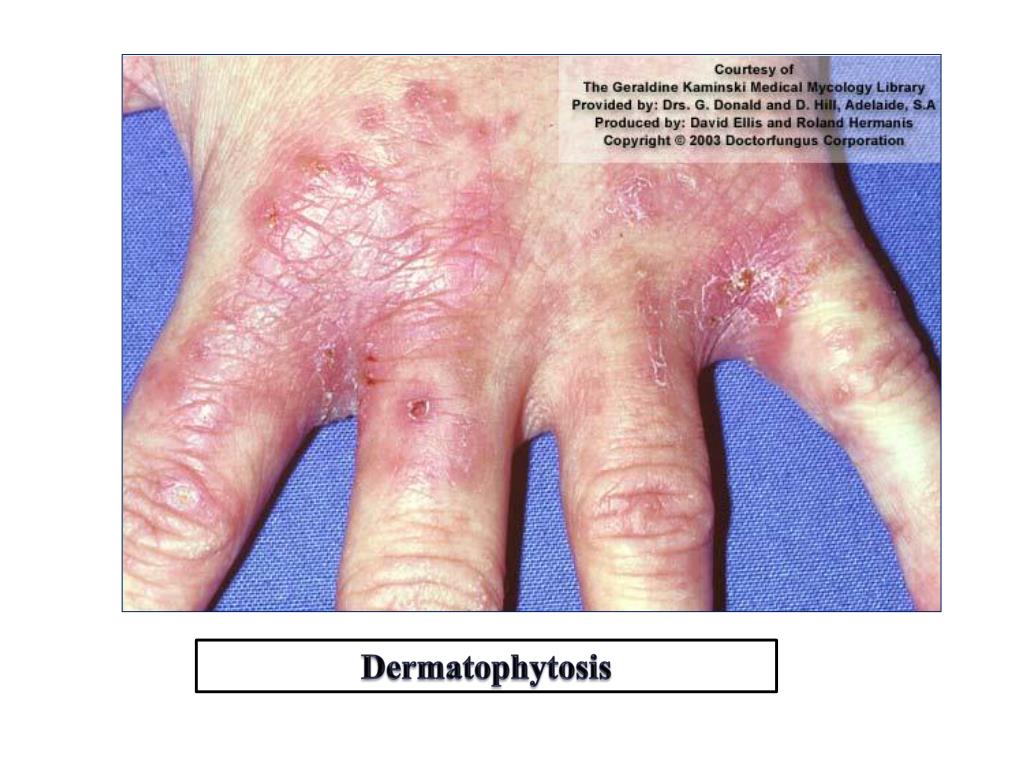 PPT Medical Mycology PowerPoint Presentation, free download ID2067414