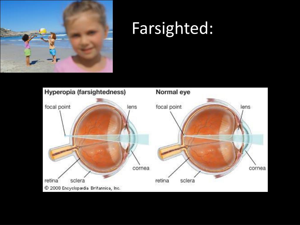 PPT Refractive Surgery Seminar An Introduction to Laser Vision