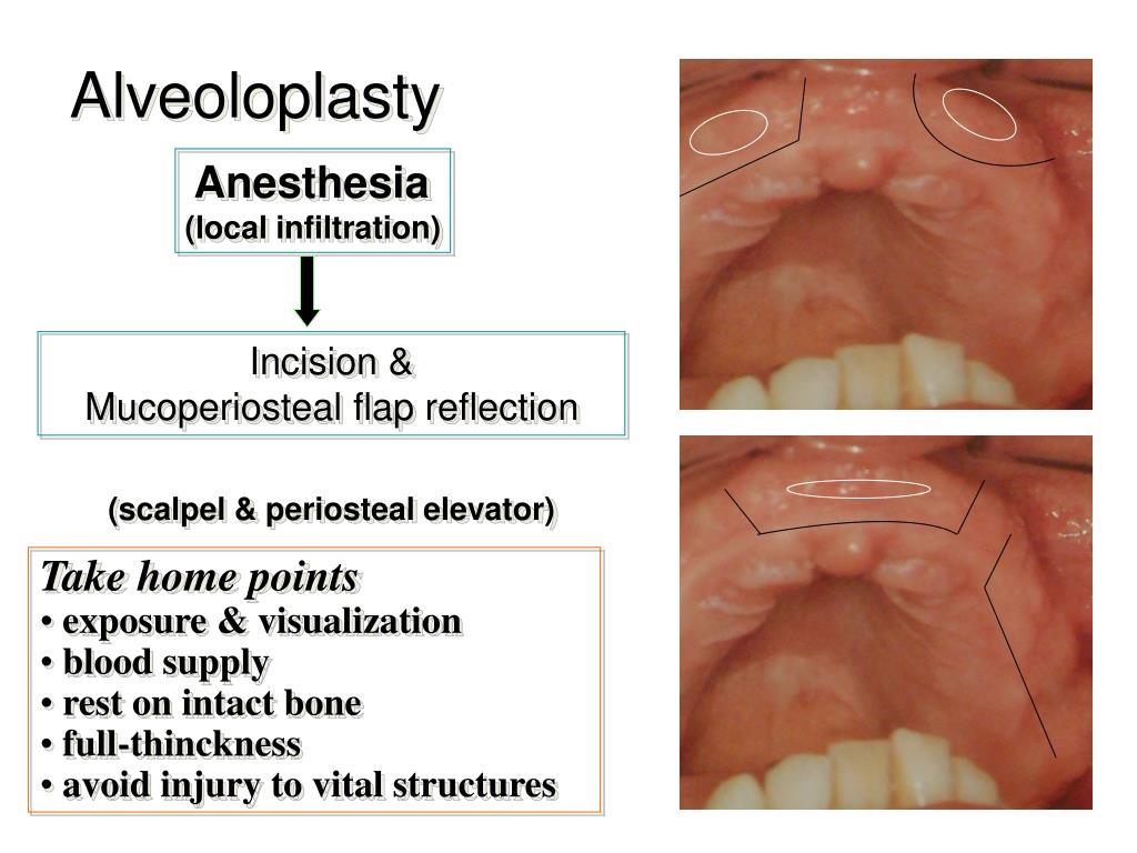 PPT Preprosthetic Surgery PowerPoint Presentation, free download ID