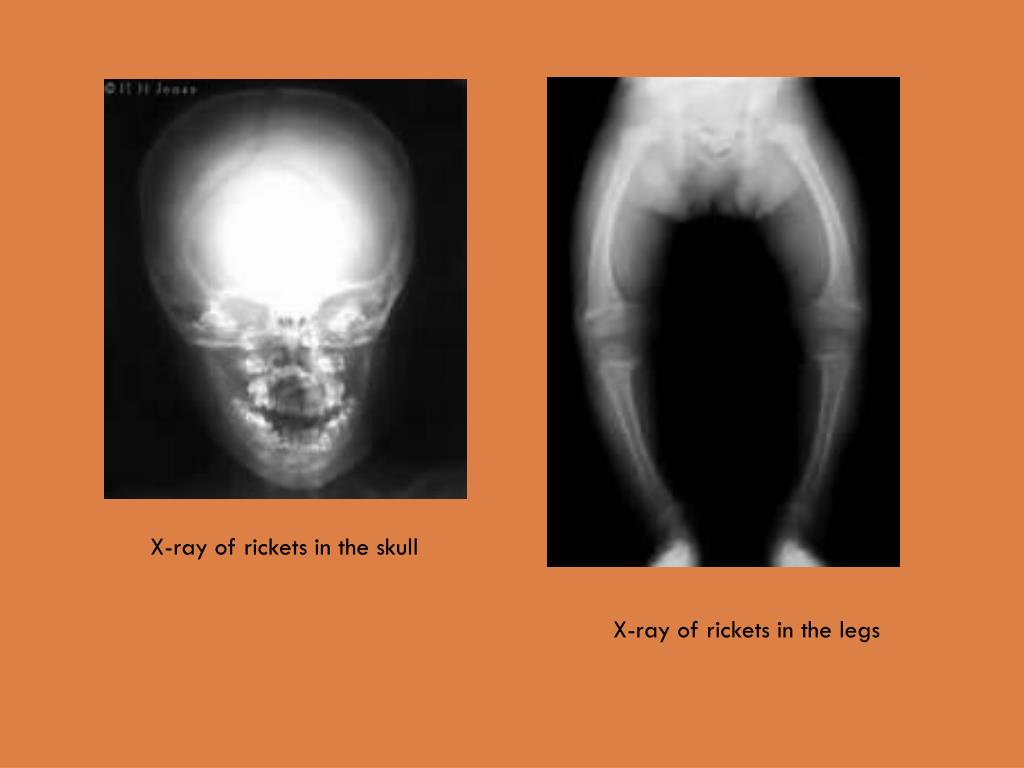 PPT Rickets ( ostemalancia ) PowerPoint Presentation, free download ID2080445