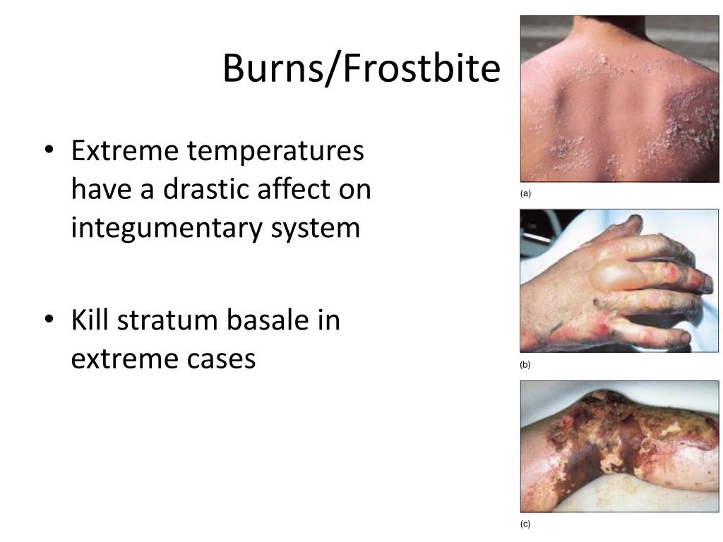 PPT Homeostatic Imbalances Integumentary System PowerPoint