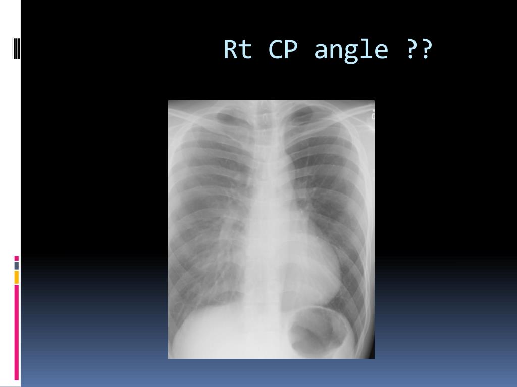 PPT How to read X’Ray chest PowerPoint Presentation, free download