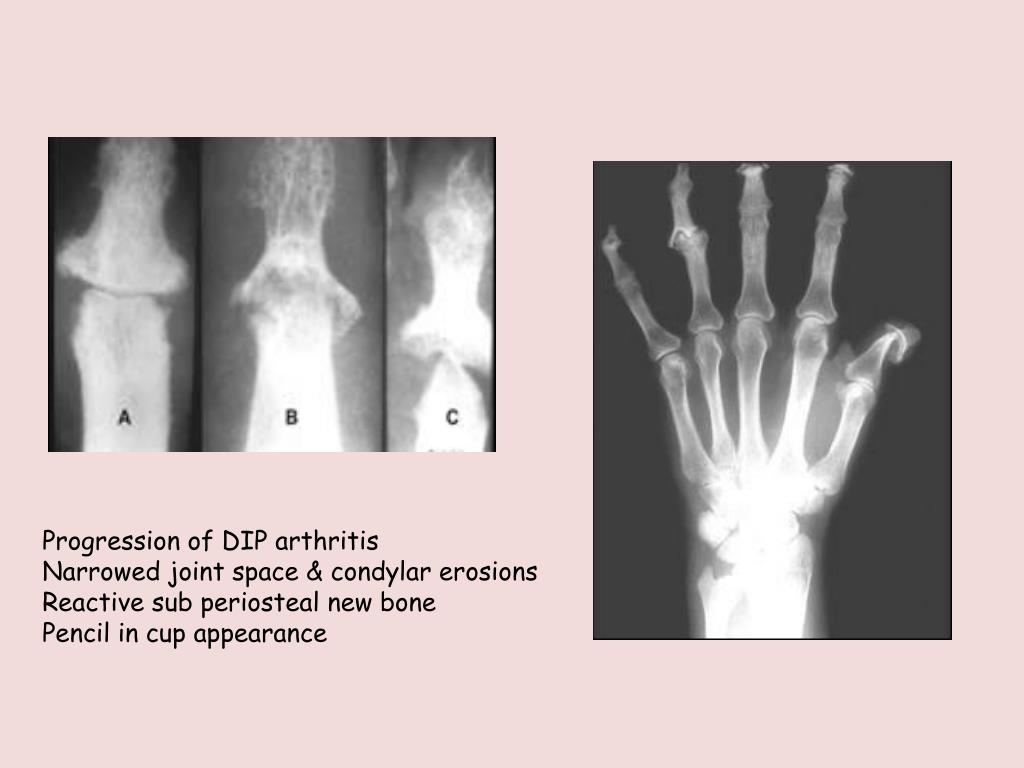 PPT Seronegative Arthritis Or Spondyloartropaties PowerPoint