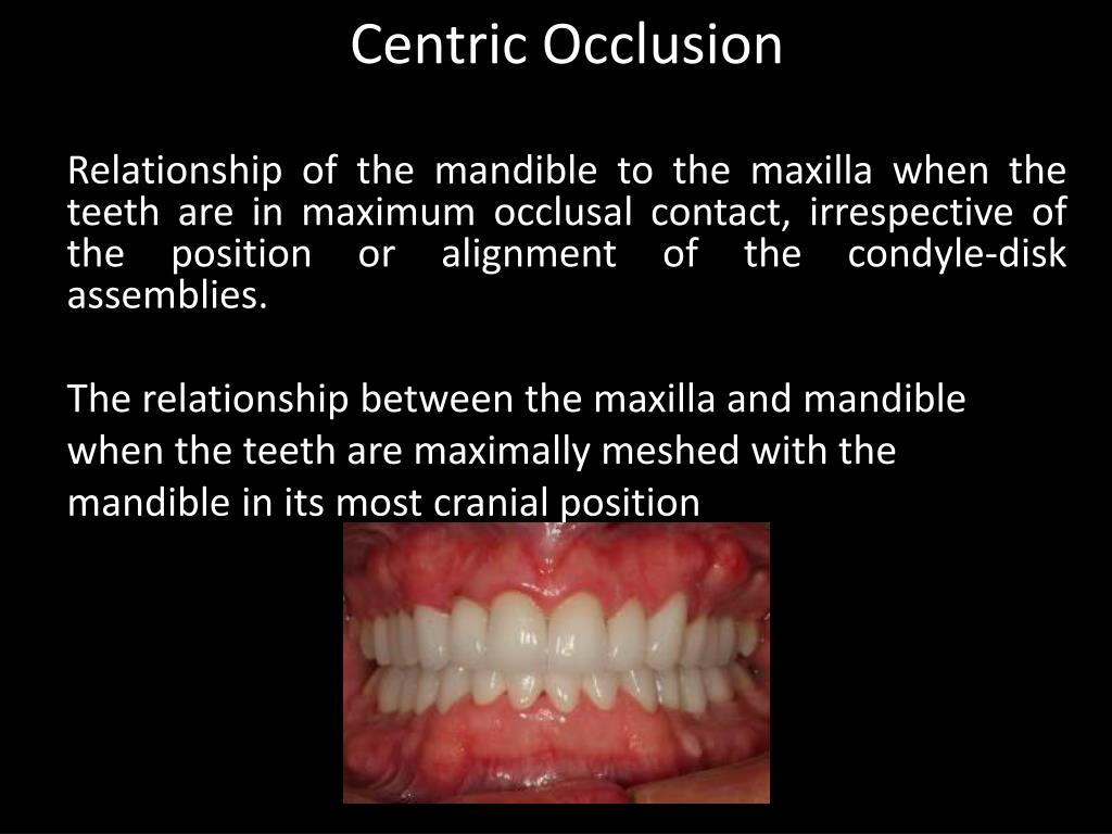 PPT Fundamentals Of Occlusion PowerPoint Presentation, free download