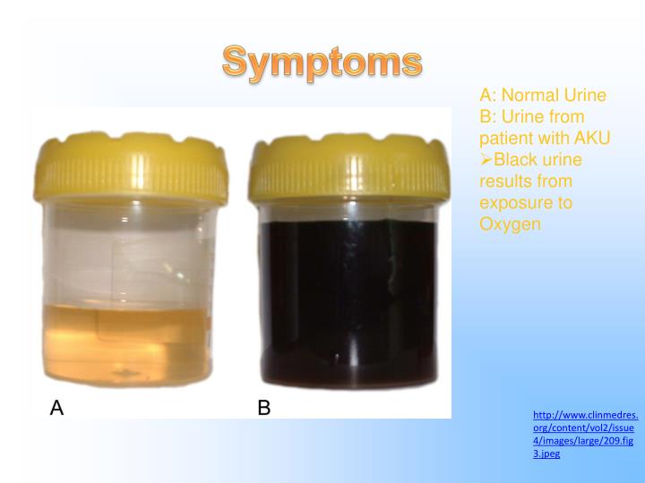 PPT Alkaptonuria (Black Urine Disease) PowerPoint Presentation ID