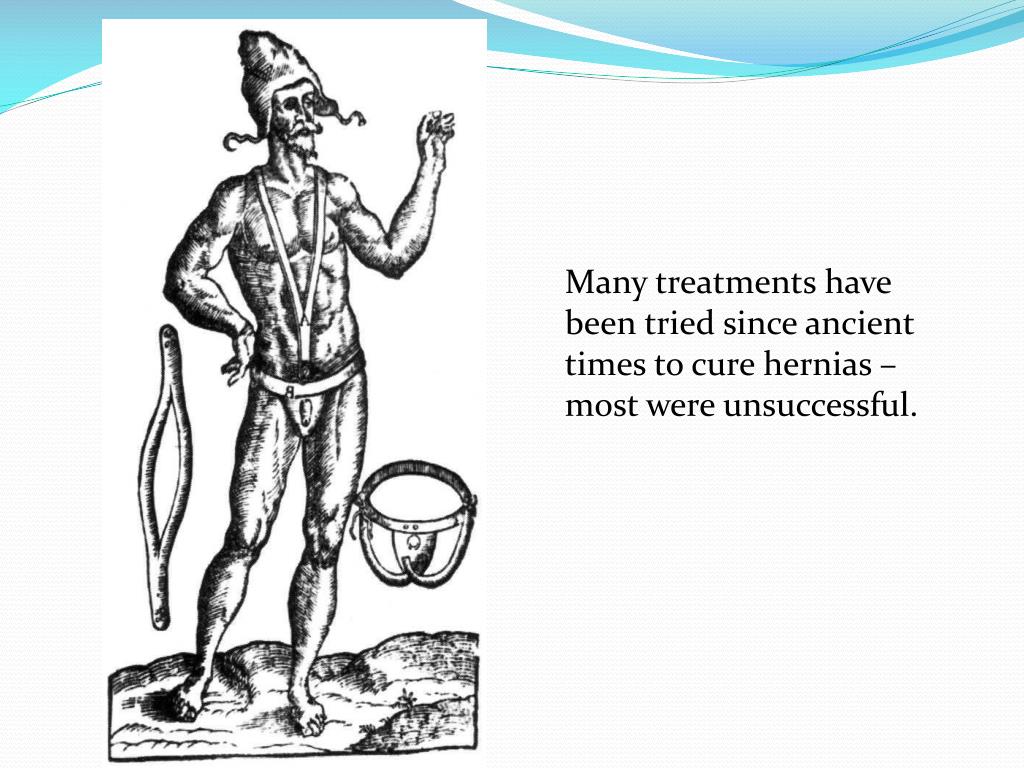PPT What’s New in Hernia Surgery PowerPoint Presentation, free